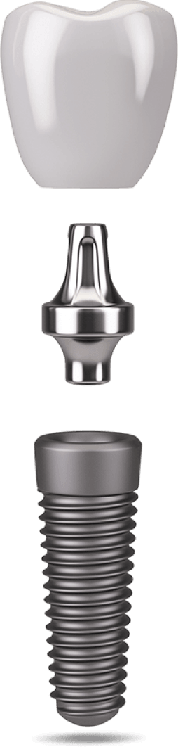 dental implant model 1