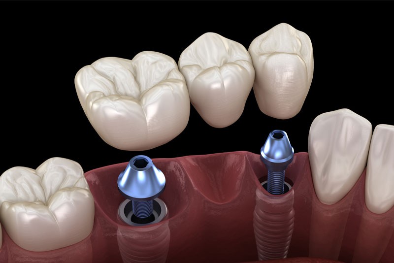Dental Implant Bridge