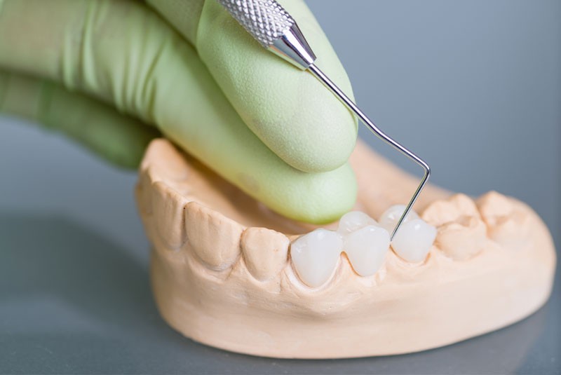 dental bridge