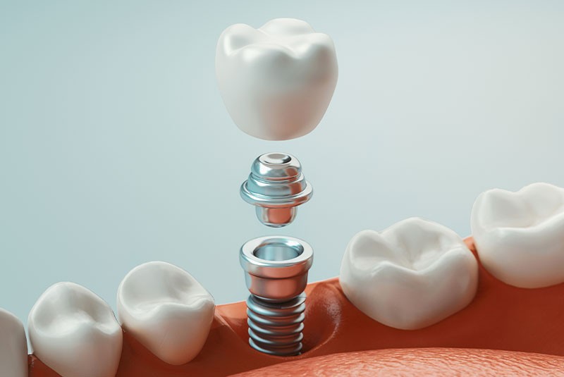 Dental Implants Near Me Lake Oswego OR