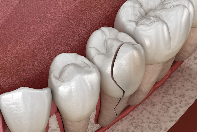 An image representing a need for porcelain teeth veneers in Portland, OR