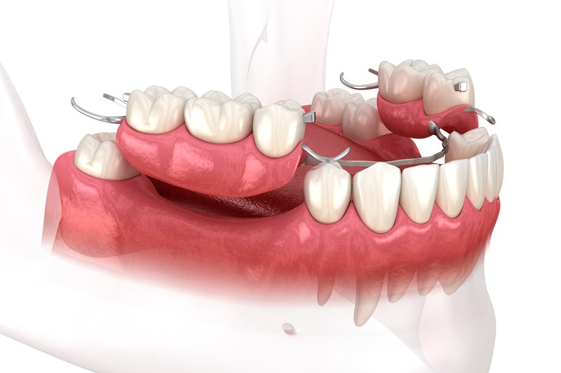 Temporary vs. Final Prosthesis: Understanding the Contrasts