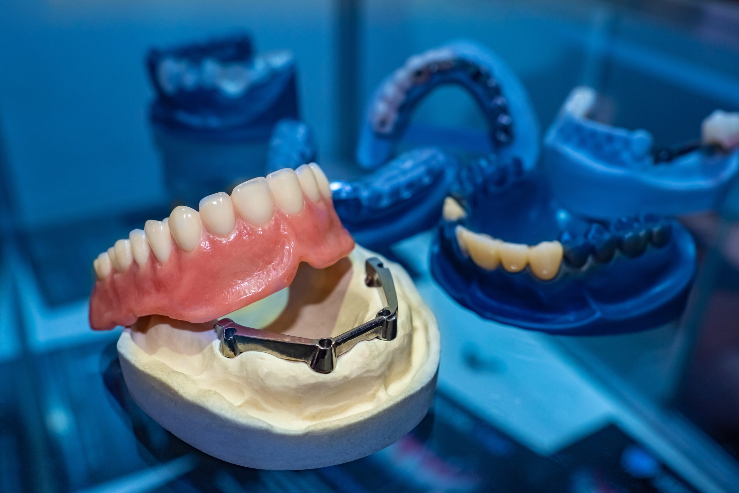 Impact of Delaying Dental Implants on Jawbone Health Explained