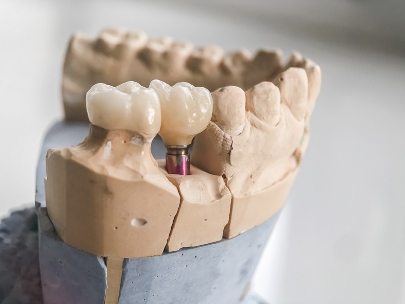 Dental Implant Procedures: Factors for Treatment Options