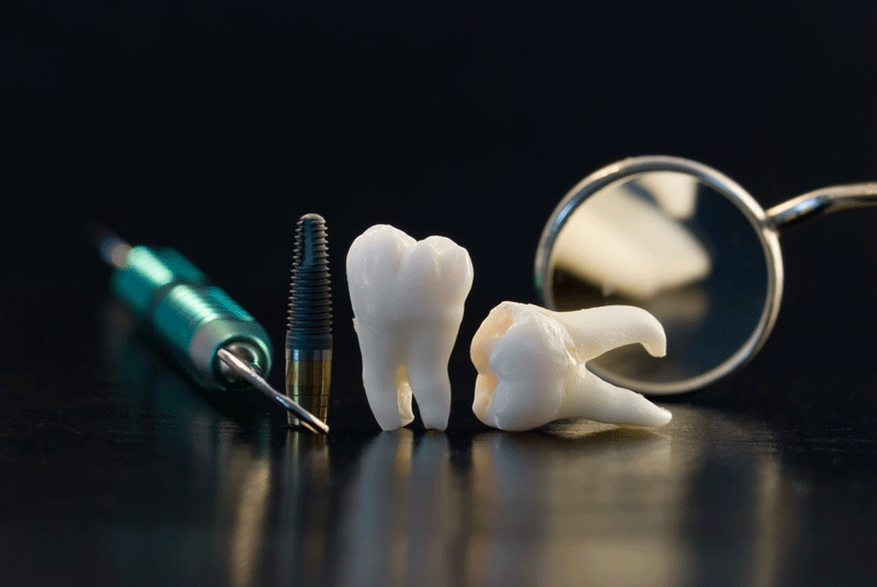 Understanding a Full Mouth Dental Implant Procedure Step by Step