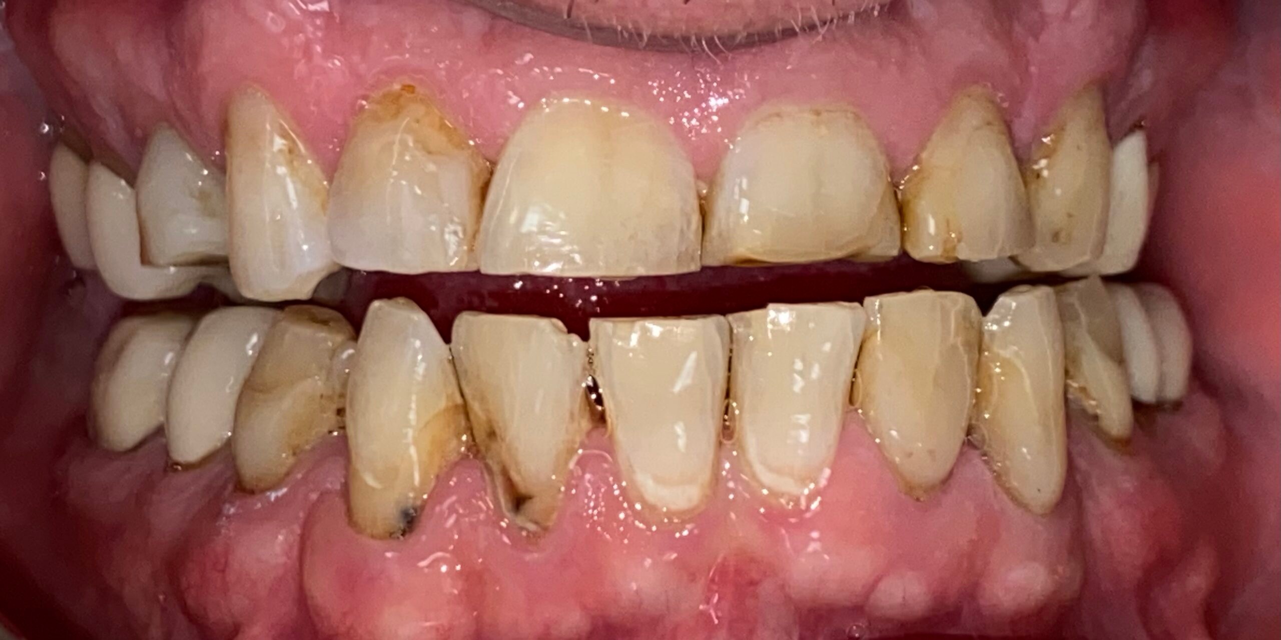 Transforming a Smile: A Full Mouth Rehabilitation Story
