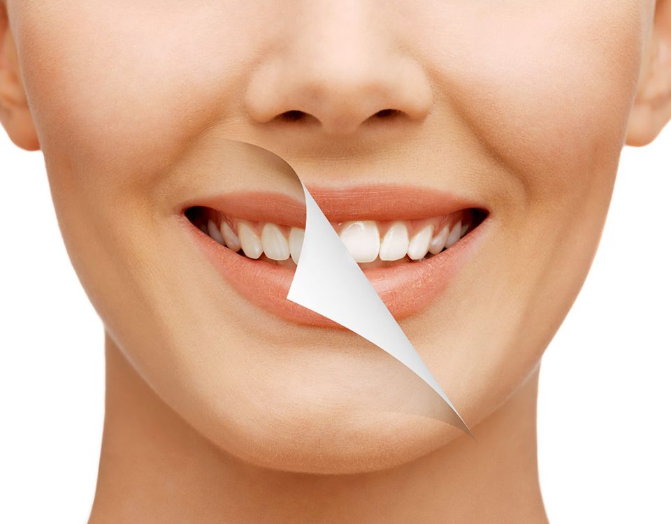Is Teeth Whitening Safe? What Centerport Patients Need to Know