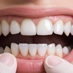 Top 7 Benefits of Full Mouth Dental Implants for Long-Term Oral Health