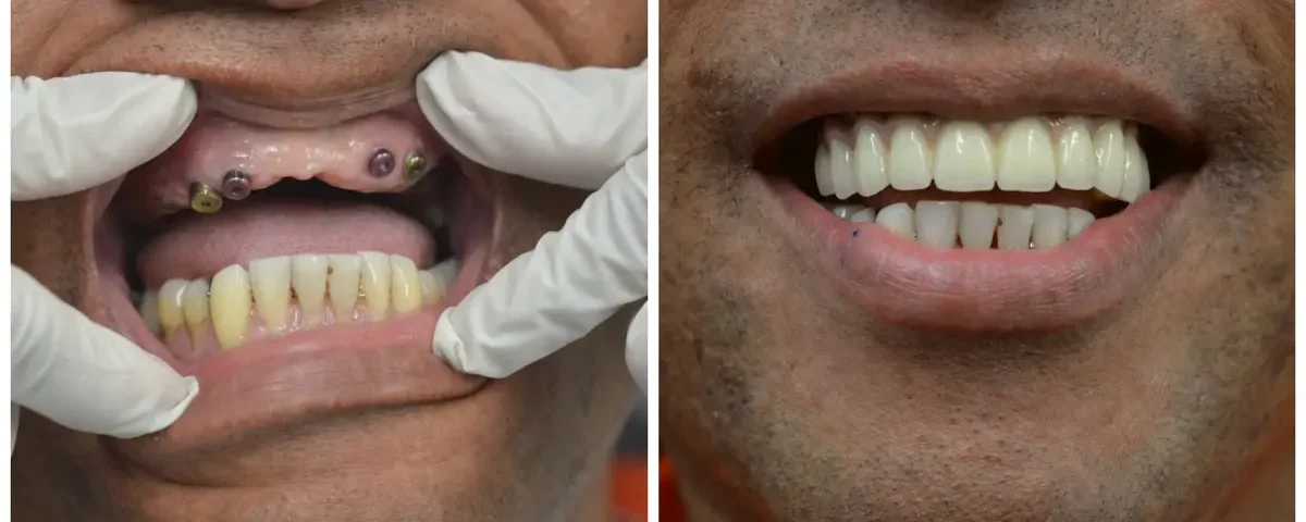 How Do You Know If You’re a Candidate for Full Mouth Reconstruction?