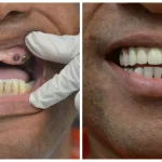How Do You Know If You’re a Candidate for Full Mouth Reconstruction?